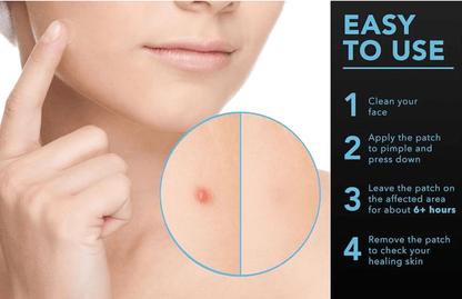 AcneOff Invisible Acne Removal Pimple Patches